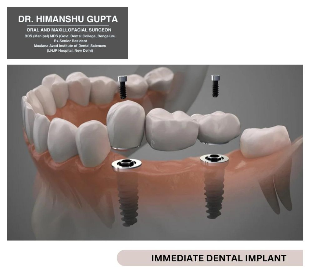 Visual representation of immediate dental implant procedure with implant posts being placed in the jaw for tooth replacement, demonstrated by Dr. Himanshu Gupta, oral surgeon in Gurgaon."