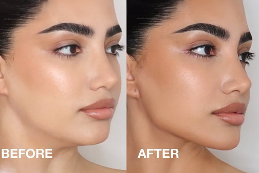 A split photograph labeled "BEFORE" (left) and "AFTER" (right) showing a woman's lower face and neck, illustrating a significantly more defined jawline and improved neck contour in the "After" image.