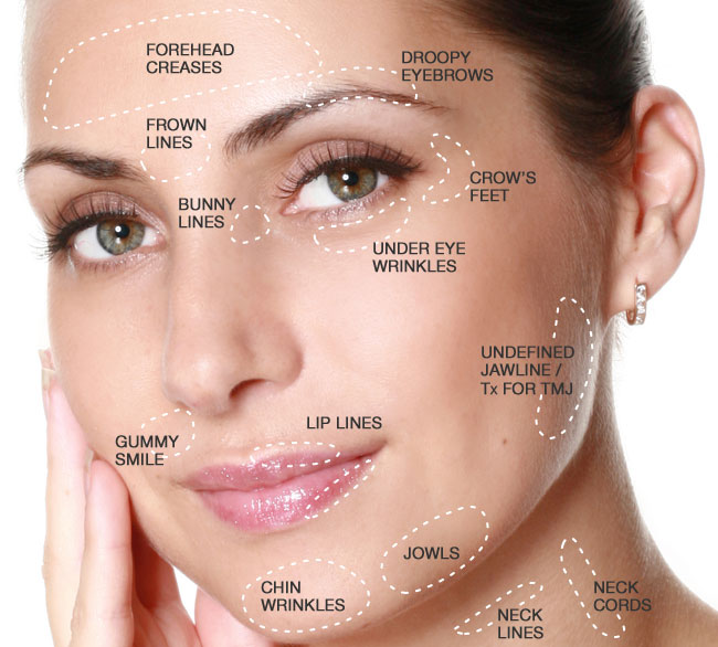 A medical graphic showing a woman's face with various areas outlined by dotted lines and labeled, indicating common aesthetic treatment areas like Forehead creases, Frown lines, Crow's feet, Undereye wrinkles, Gummy smile, Lip lines, Chin wrinkles, Jowls, Undefined jawline, Neck lines, and Neck cords.