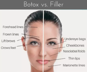 A medical graphic titled "Botox vs. Filler," showing a woman's face split in half, with labels and dotted lines pointing to areas treated by Botox on the left side (Forehead lines, Frown lines, Lift brows, Crows feet) and areas treated by Filler on the right side (Undereye bags, Cheekbones, Nasolabial folds, Thin lips, Marionette lines).