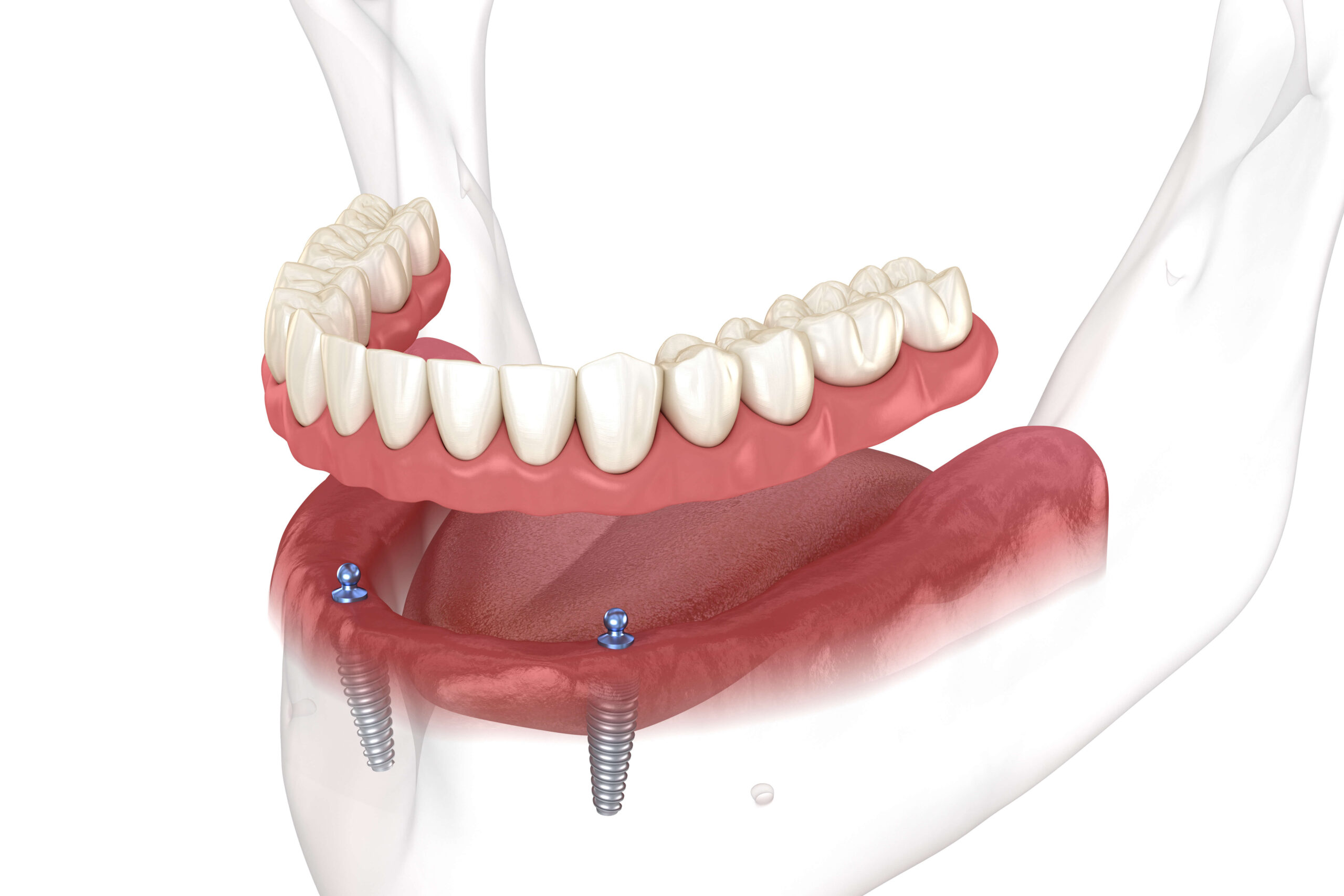 A 3D medical illustration showing a cross-section of a jawbone with two dental implants inserted, illustrating how they support a lower full denture (overdenture), with a full upper denture also shown, depicting an implant-supported overdenture system.