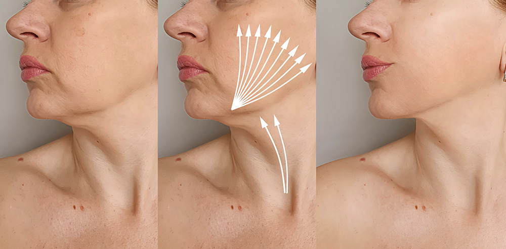 A three-panel medical illustration showing a woman's lower face and neck: "Before" (left) with skin laxity, the procedure with white arrows indicating lift (middle), and "After" (right) with tightened and lifted skin.